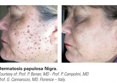 Smartxide2 Dot RF Applicazioni 5